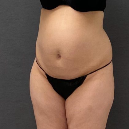 Abdominoplasty Before & After Patient #15950