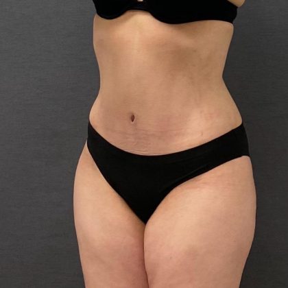 Abdominoplasty Before & After Patient #15950