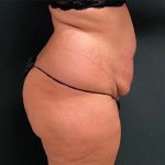 Abdominoplasty Before & After Patient #15951