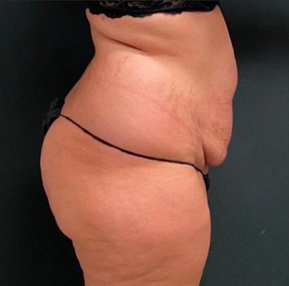 Abdominoplasty Before & After Patient #15951