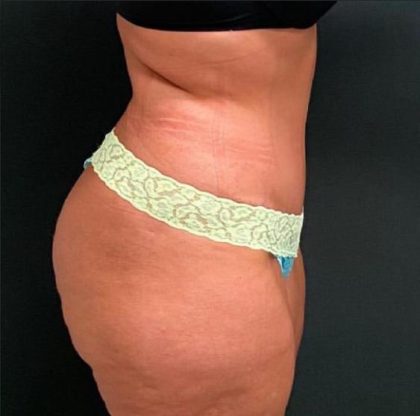 Abdominoplasty Before & After Patient #15951
