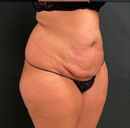 Abdominoplasty Before & After Patient #15951
