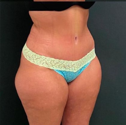 Abdominoplasty Before & After Patient #15951