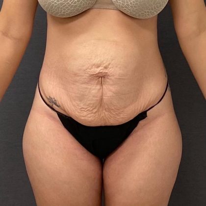 Abdominoplasty Before & After Patient #15952
