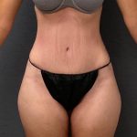 Abdominoplasty Before & After Patient #15952