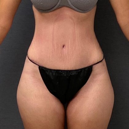 Abdominoplasty Before & After Patient #15952