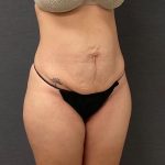 Abdominoplasty Before & After Patient #15952