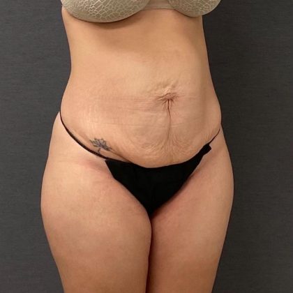 Abdominoplasty Before & After Patient #15952
