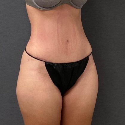 Abdominoplasty Before & After Patient #15952