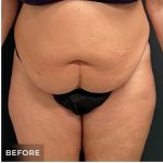 Abdominoplasty Before & After Patient #15908