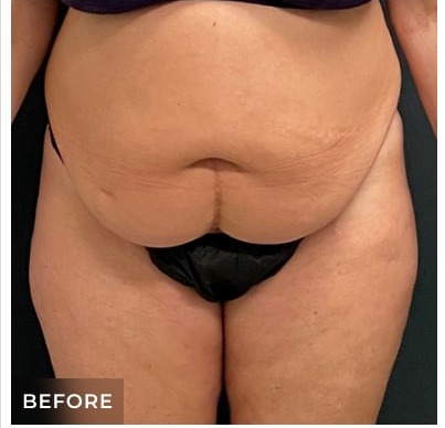 Abdominoplasty Before & After Patient #15908