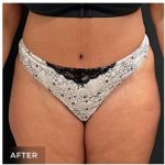 Abdominoplasty Before & After Patient #15908
