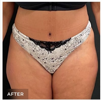 Abdominoplasty Before & After Patient #15908