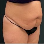 Abdominoplasty Before & After Patient #15908