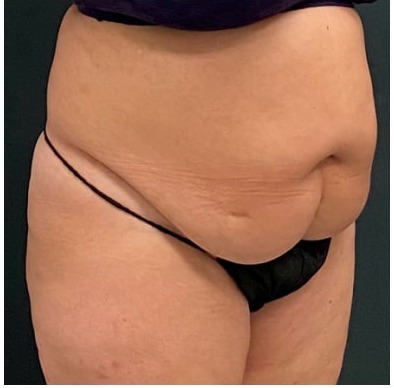 Abdominoplasty Before & After Patient #15908