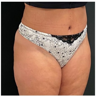Abdominoplasty Before & After Patient #15908