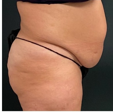 Abdominoplasty Before & After Patient #15908