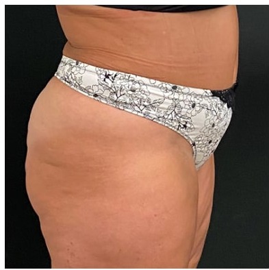 Abdominoplasty Before & After Patient #15908