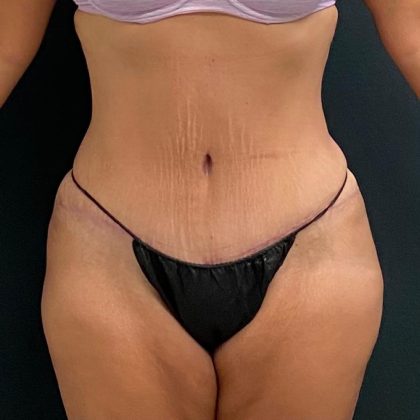Abdominoplasty Before & After Patient #15953