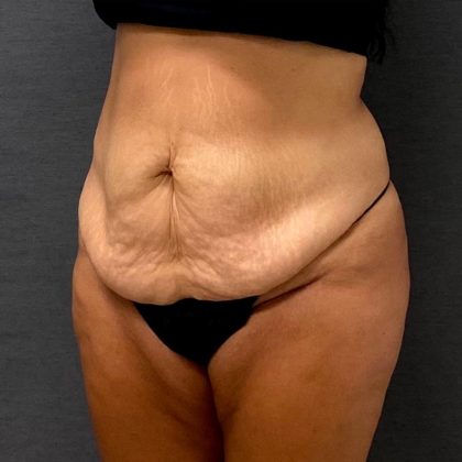 Abdominoplasty Before & After Patient #15953