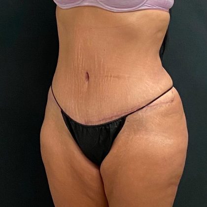 Abdominoplasty Before & After Patient #15953