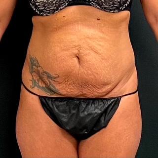 Abdominoplasty Before & After Patient #15954