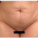 Abdominoplasty Before & After Patient #15909