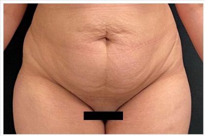 Abdominoplasty Before & After Patient #15909
