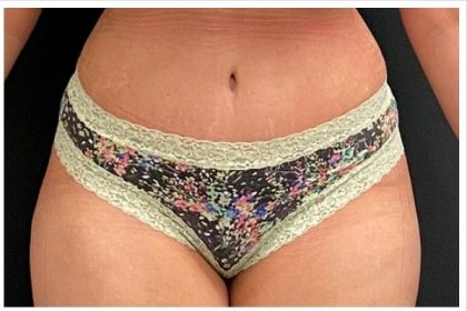 Abdominoplasty Before & After Patient #15909