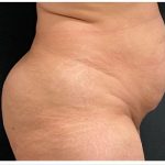 Abdominoplasty Before & After Patient #15909