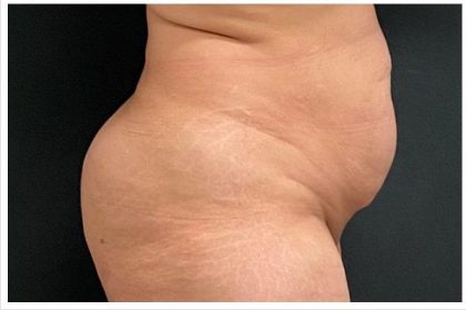 Abdominoplasty Before & After Patient #15909