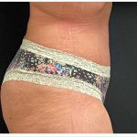 Abdominoplasty Before & After Patient #15909