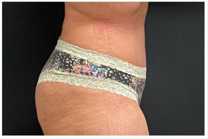 Abdominoplasty Before & After Patient #15909
