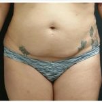 Abdominoplasty Before & After Patient #15910