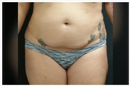 Abdominoplasty Before & After Patient #15910