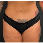 Abdominoplasty Before & After Patient #15910