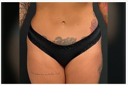 Abdominoplasty Before & After Patient #15910