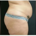 Abdominoplasty Before & After Patient #15910