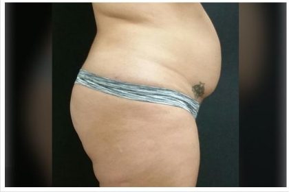 Abdominoplasty Before & After Patient #15910