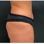 Abdominoplasty Before & After Patient #15910