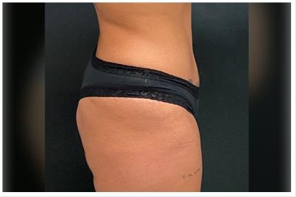 Abdominoplasty Before & After Patient #15910