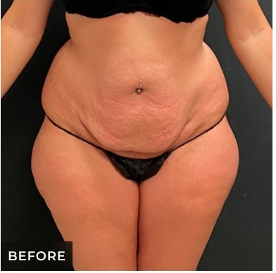 Abdominoplasty Before & After Patient #15911