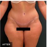 Abdominoplasty Before & After Patient #15911