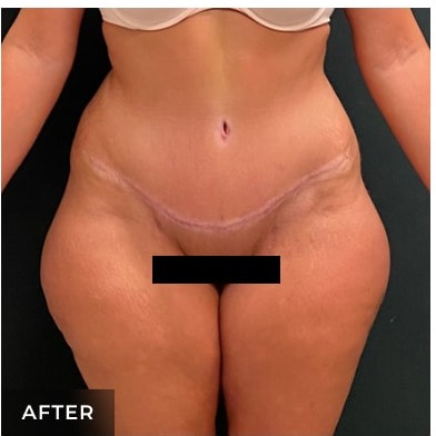Abdominoplasty Before & After Patient #15911
