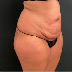 Abdominoplasty Before & After Patient #15911