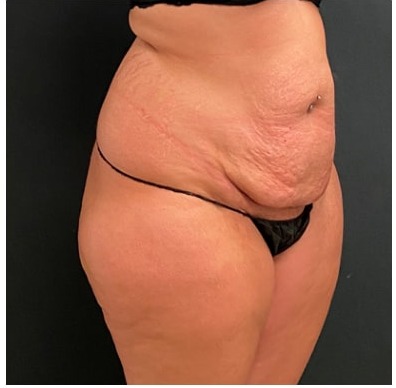 Abdominoplasty Before & After Patient #15911