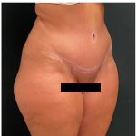 Abdominoplasty Before & After Patient #15911