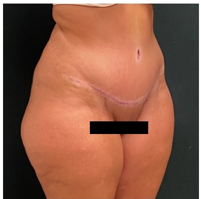 Abdominoplasty Before & After Patient #15911