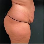 Abdominoplasty Before & After Patient #15911