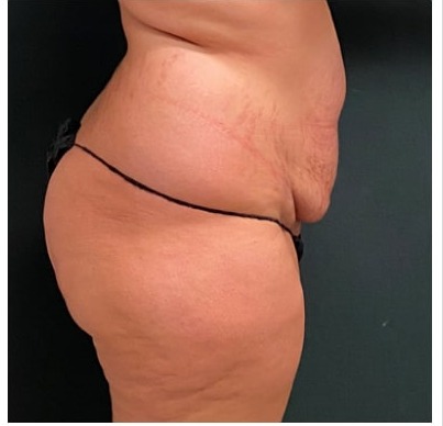 Abdominoplasty Before & After Patient #15911